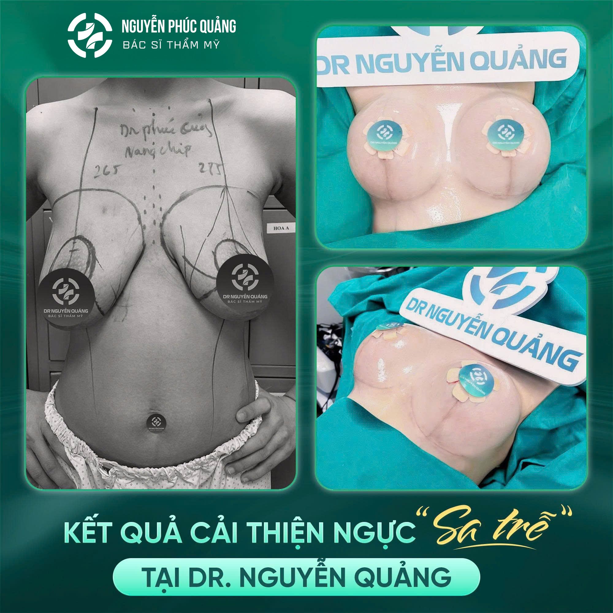 Đánh giá nâng ngực bác sĩ Nguyễn Quảng – Khách hàng nói gì?