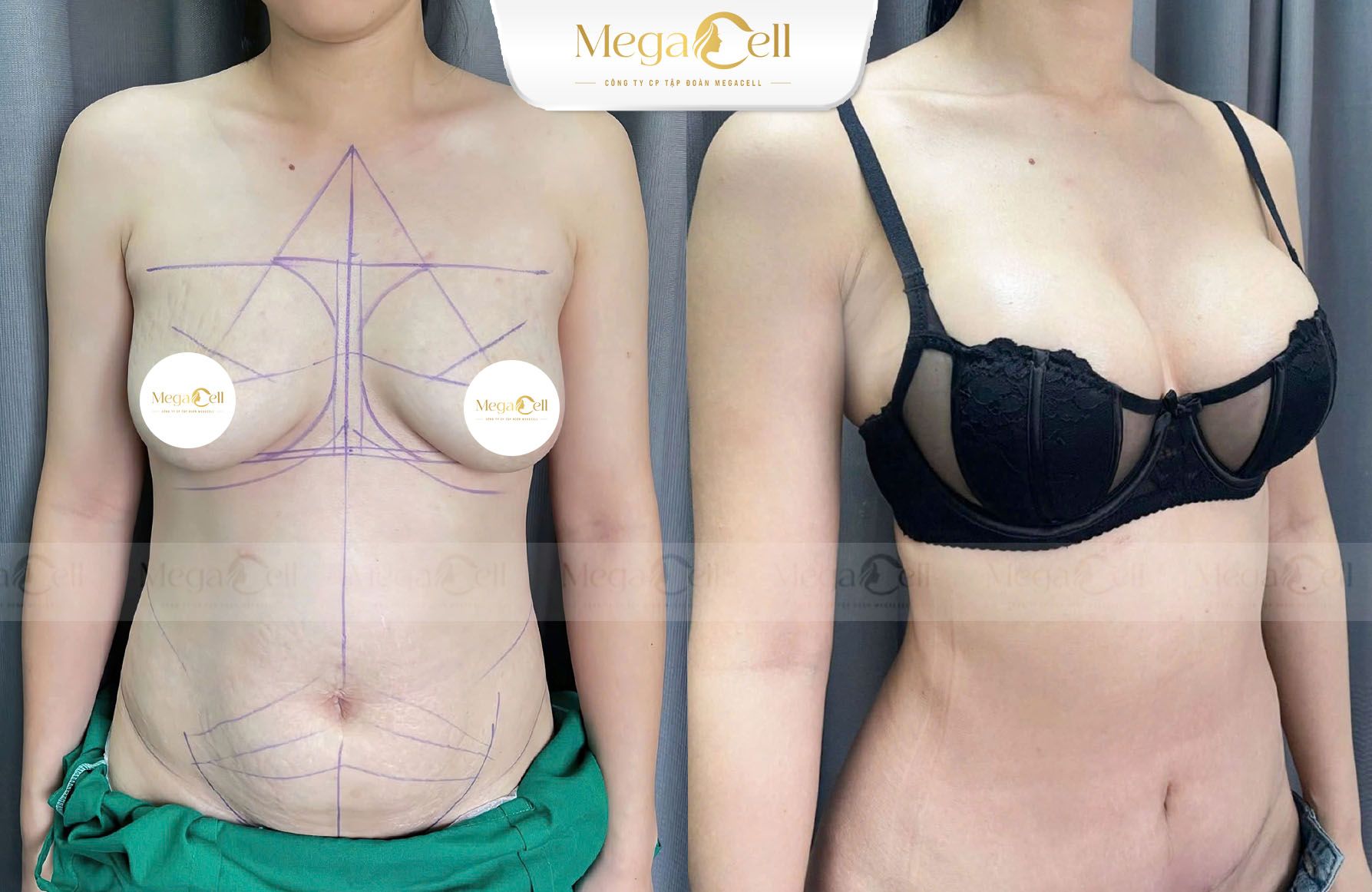 Địa chỉ nâng ngực phong thủy uy tín tại Hà Nội