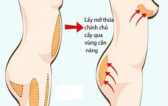 Nâng ngực bằng mỡ tự thân tại Megacell – Giải pháp làm đẹp an toàn và hiệu quả