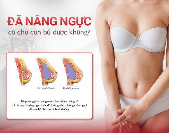 Nâng ngực có cho con bú được không? Câu trả lời từ chuyên gia Megacell