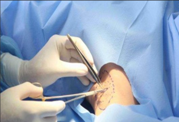 Nâng Ngực Đường Nách – Có An Toàn Và Thẩm Mỹ Hơn Không?