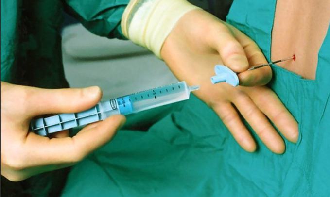 Kỹ Thuật Vô Cảm – Phương Pháp Giảm Đau Hiệu Quả Trong Phẫu Thuật Nâng Ngực