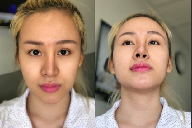 Ngực Hỏng, Mũi Hỏng? Giải Pháp Từ Bác Sĩ Nguyễn Phúc Quảng