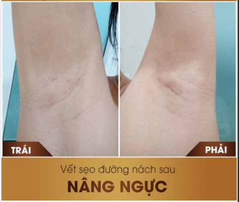 Nâng Ngực Đường Nách – Có An Toàn Và Thẩm Mỹ Hơn Không?