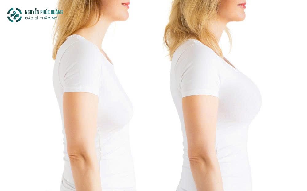 Bác sĩ Nguyễn Quảng chia sẻ giải pháp nâng ngực cho ngực lép và ngực lệch